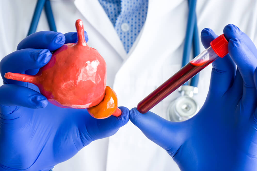 Ein Doktor hält eine Modell von einer Blase und ein Reagenzglas mit Eigenblut in den beiden Händen - Prostata Krebsvorsorge Mannheim